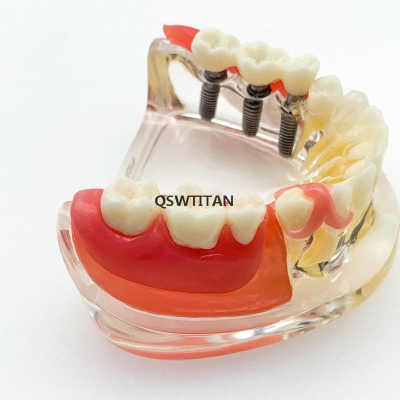 modelo didáctico implantes