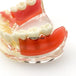 modelo didáctico implantes
