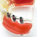 modelo didáctico implantes