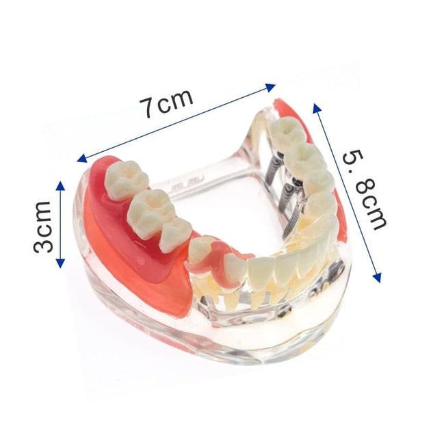 modelo didáctico implantes