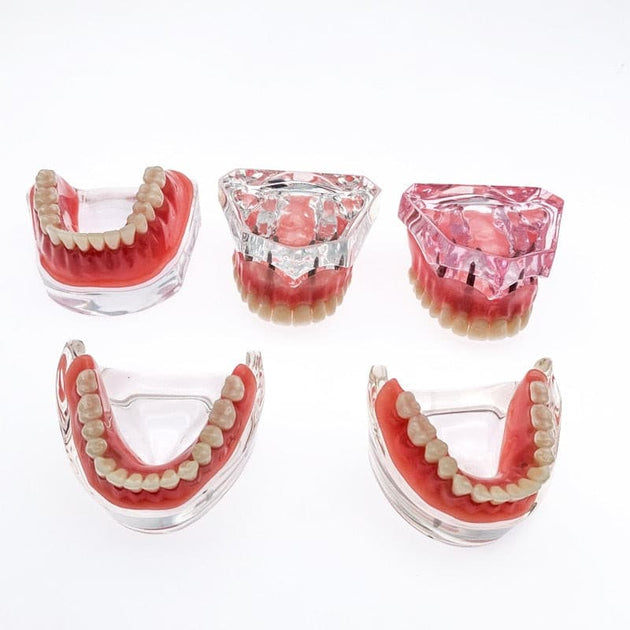 modelo prótesis dental